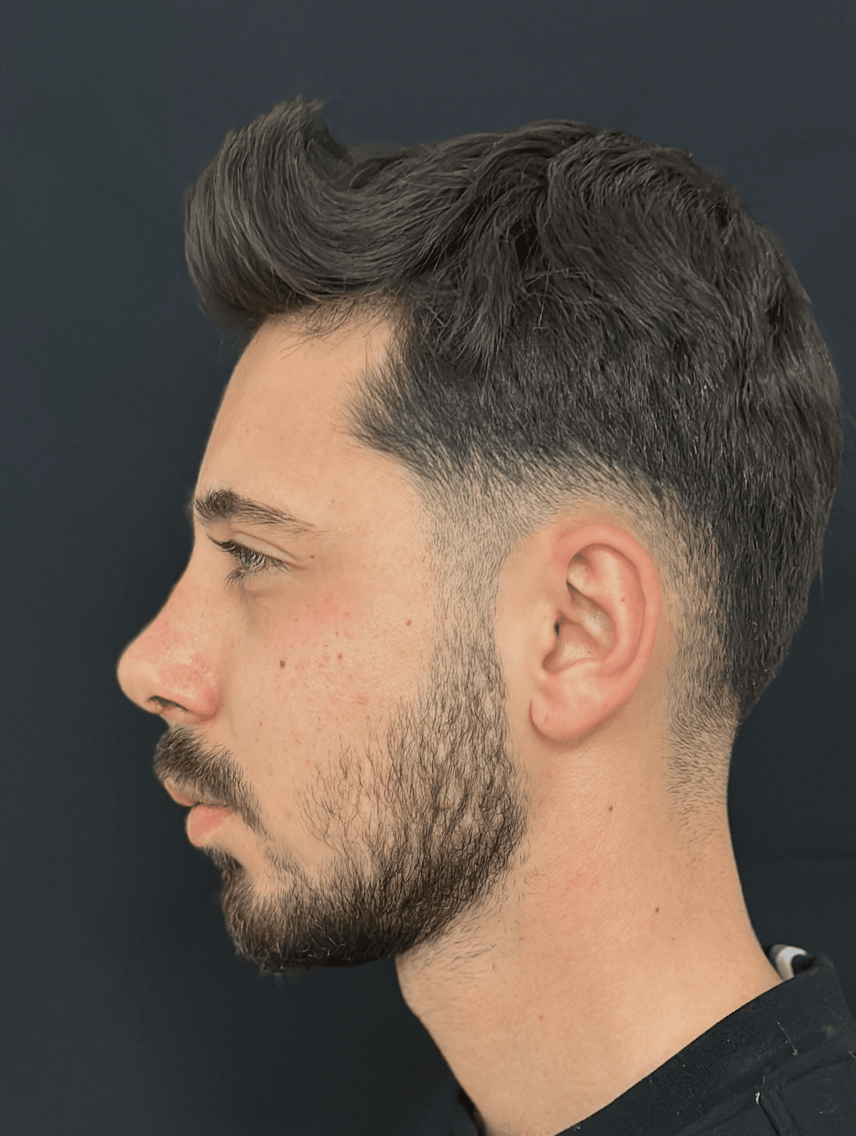 Rhinoplasty Case 2 - After