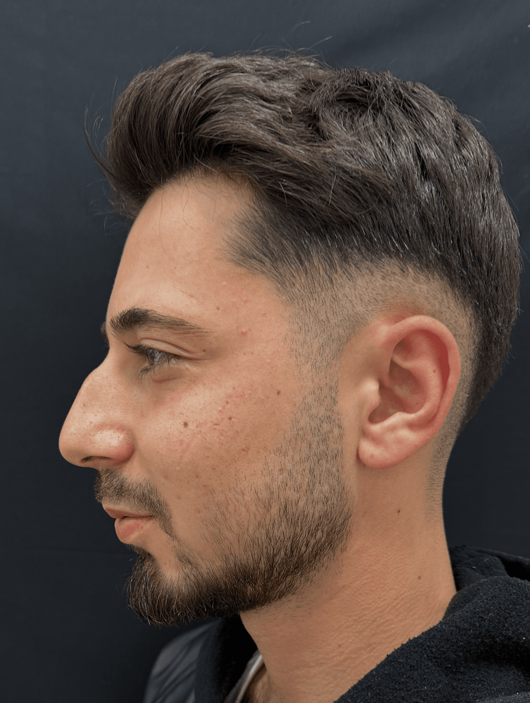 Rhinoplasty Case 2 - Before