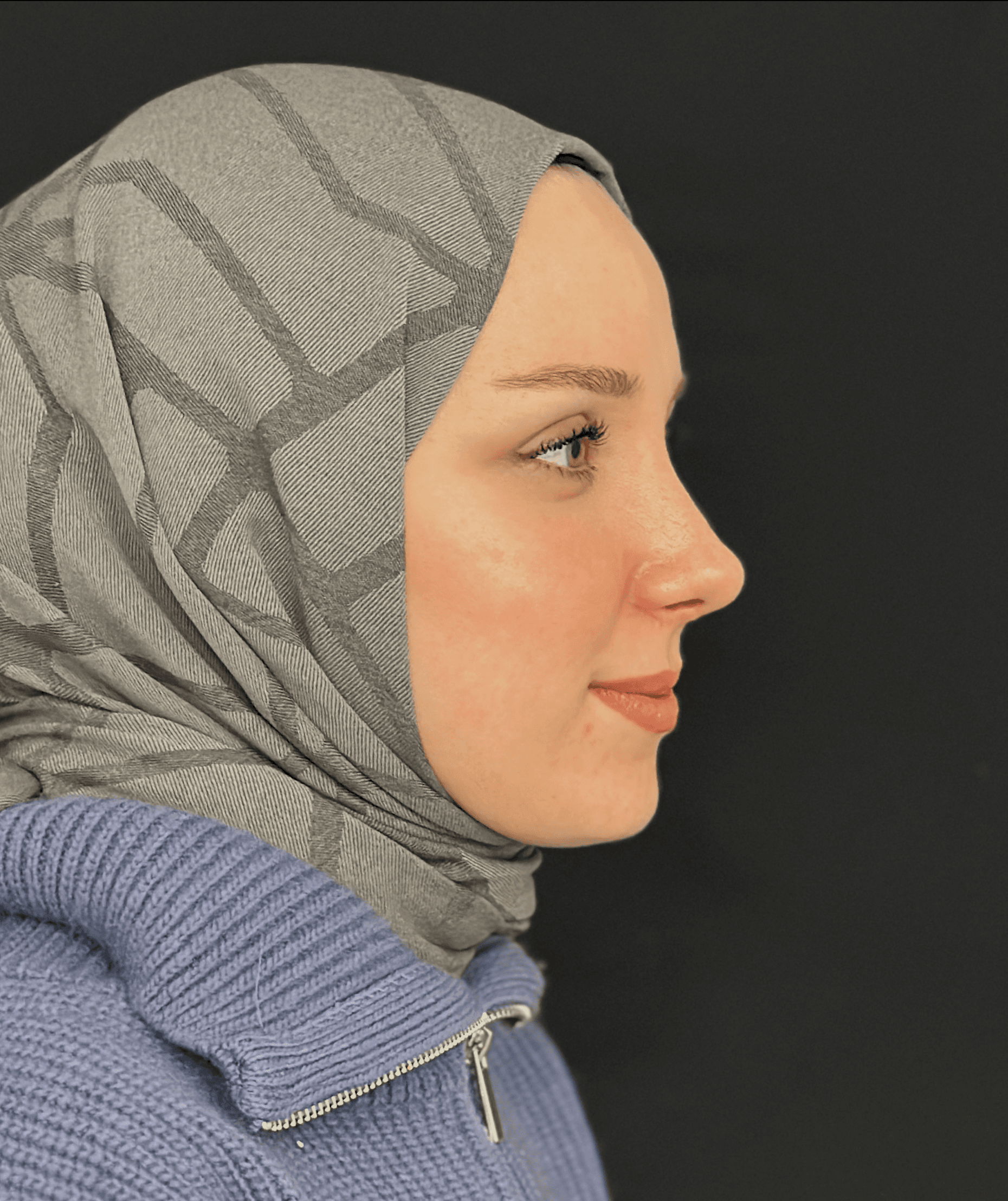 Rhinoplasty Case 3 - After