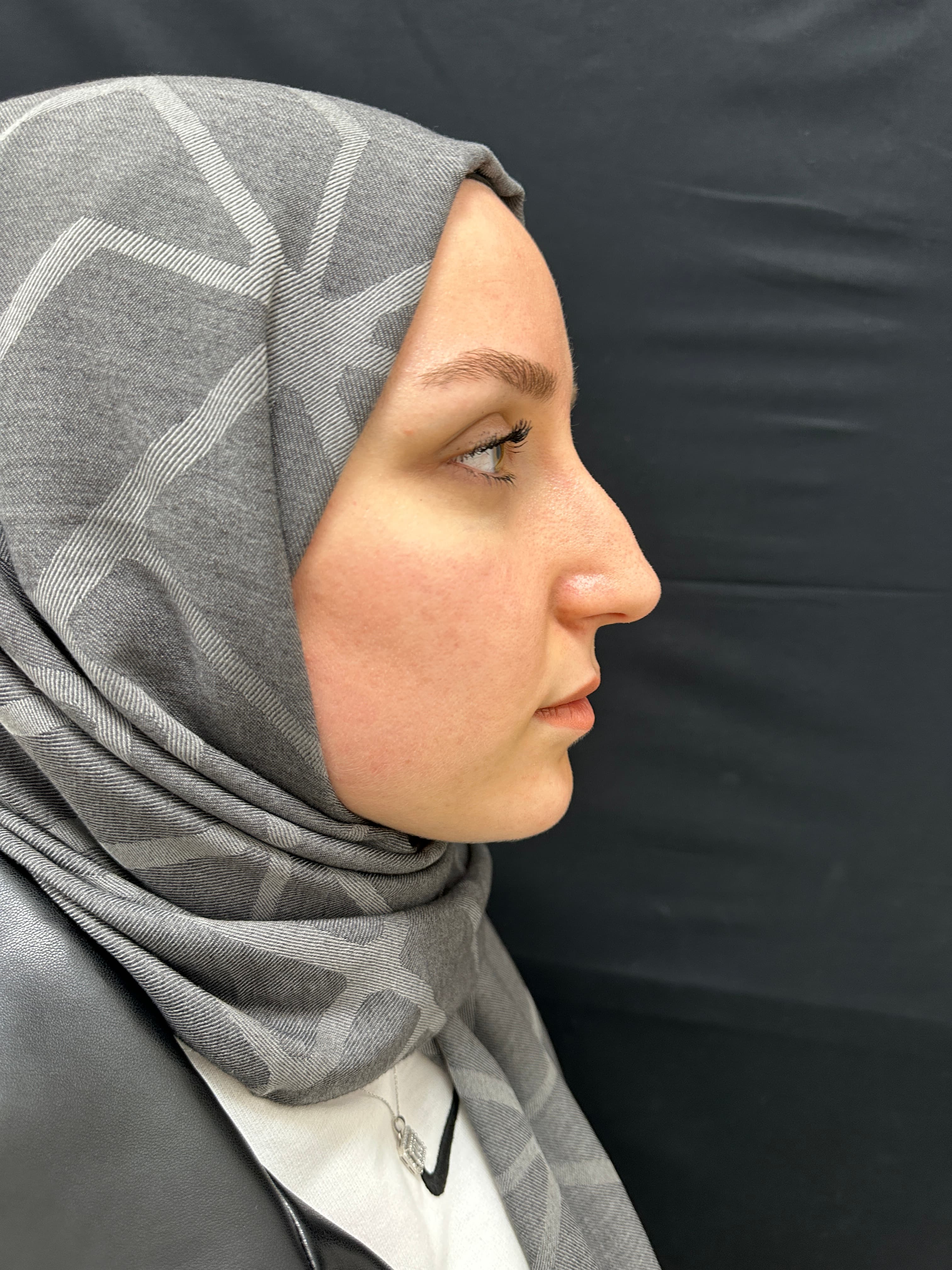 Rhinoplasty Case 3 - Before