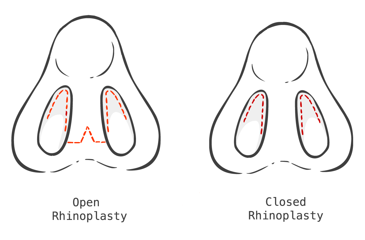 Open vs Closed Rhinoplasty