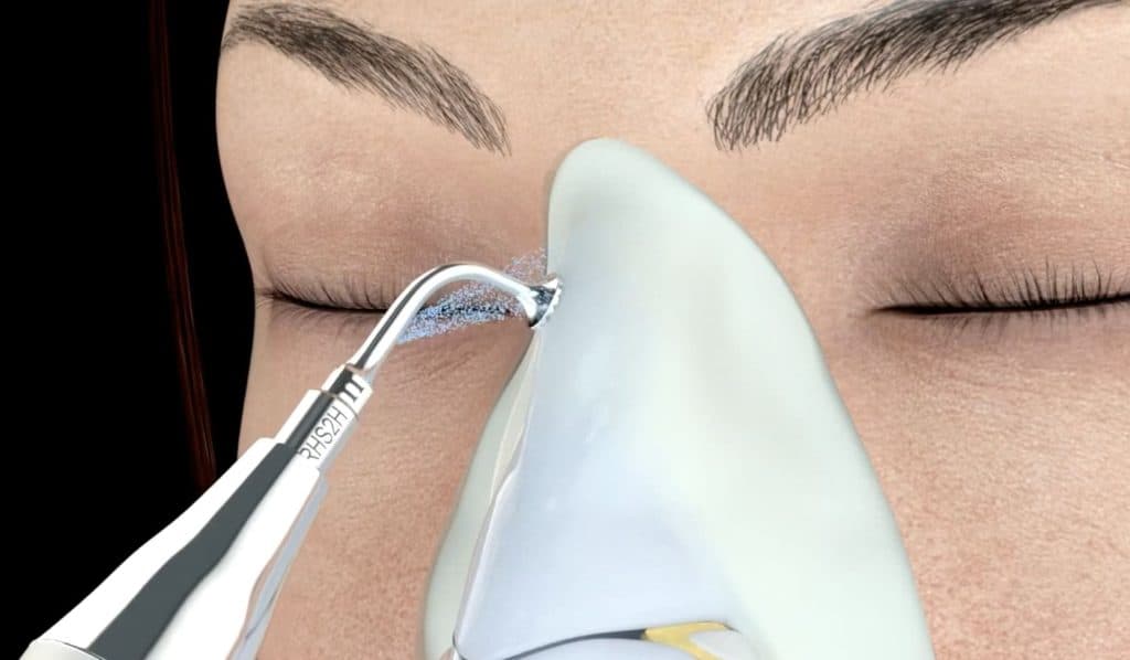 Piezo / Ultrasonic Rhinoplasty