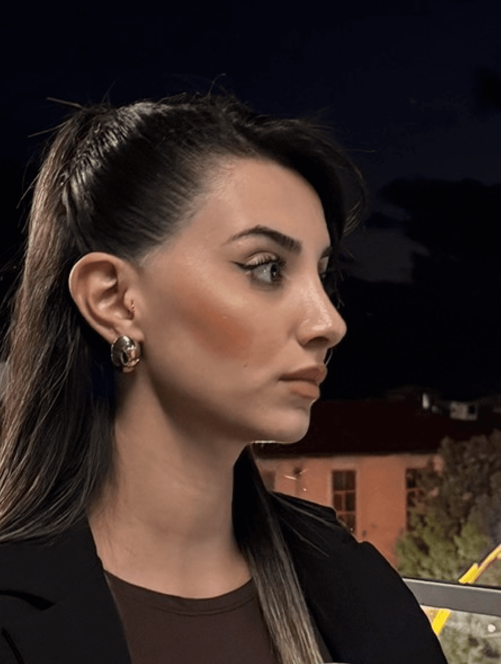 Rhinoplasty Result 4 - After