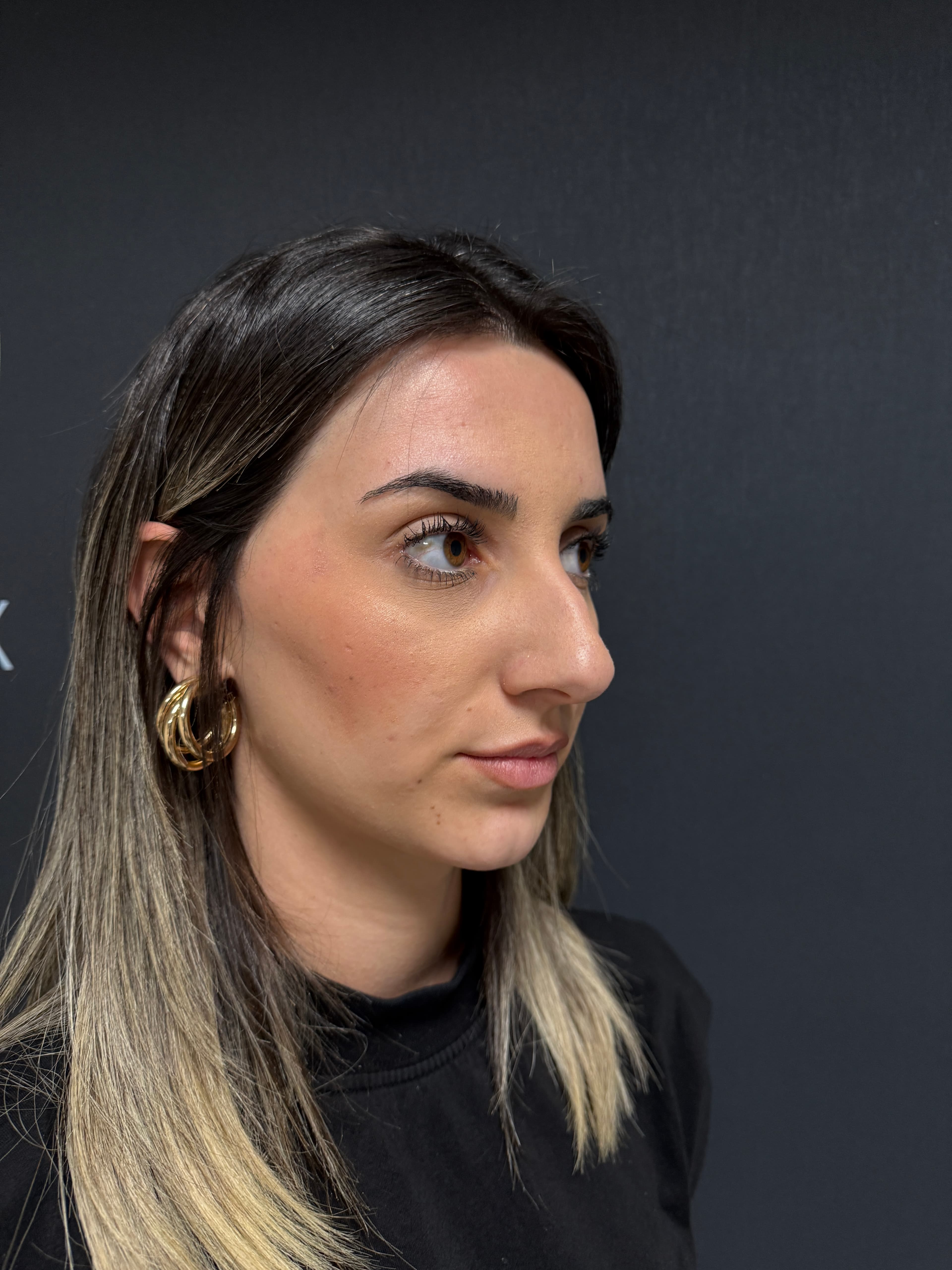 Rhinoplasty Result 4 - Before