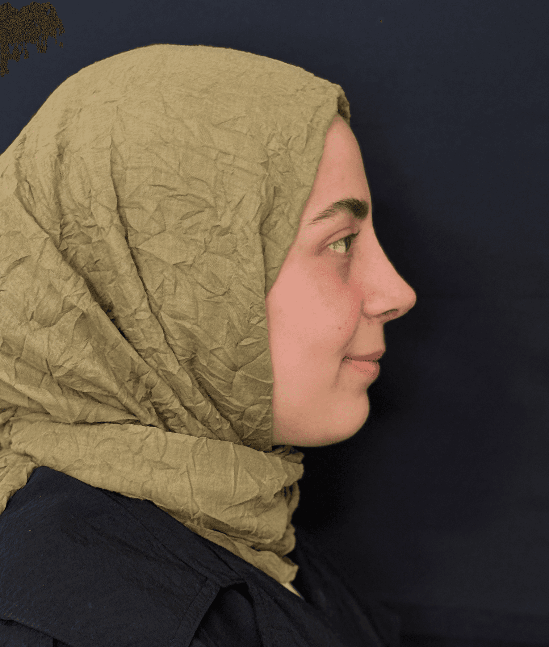 Revision Rhinoplasty Result 1 - After