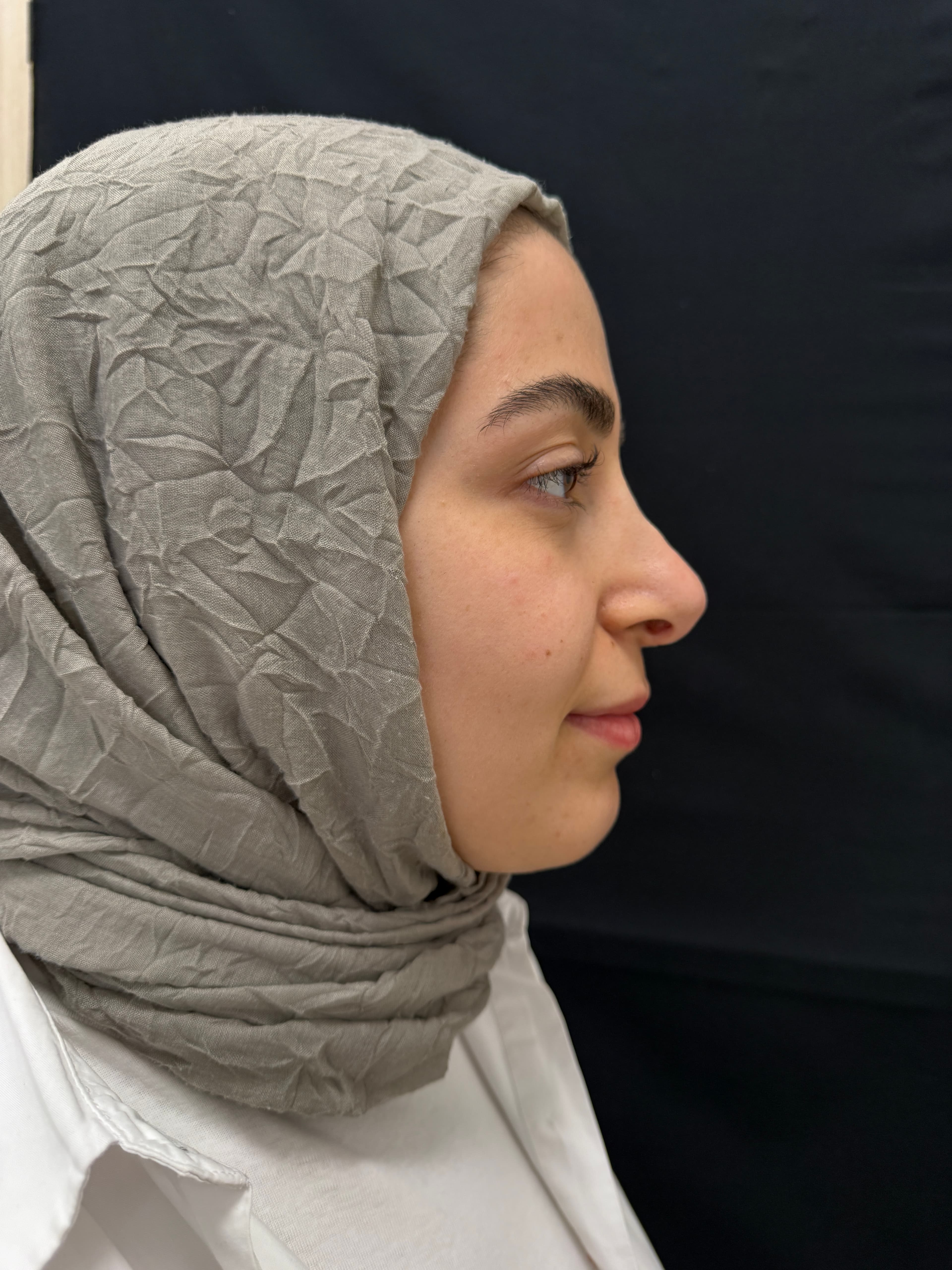 Revision Rhinoplasty Result 1 - Before