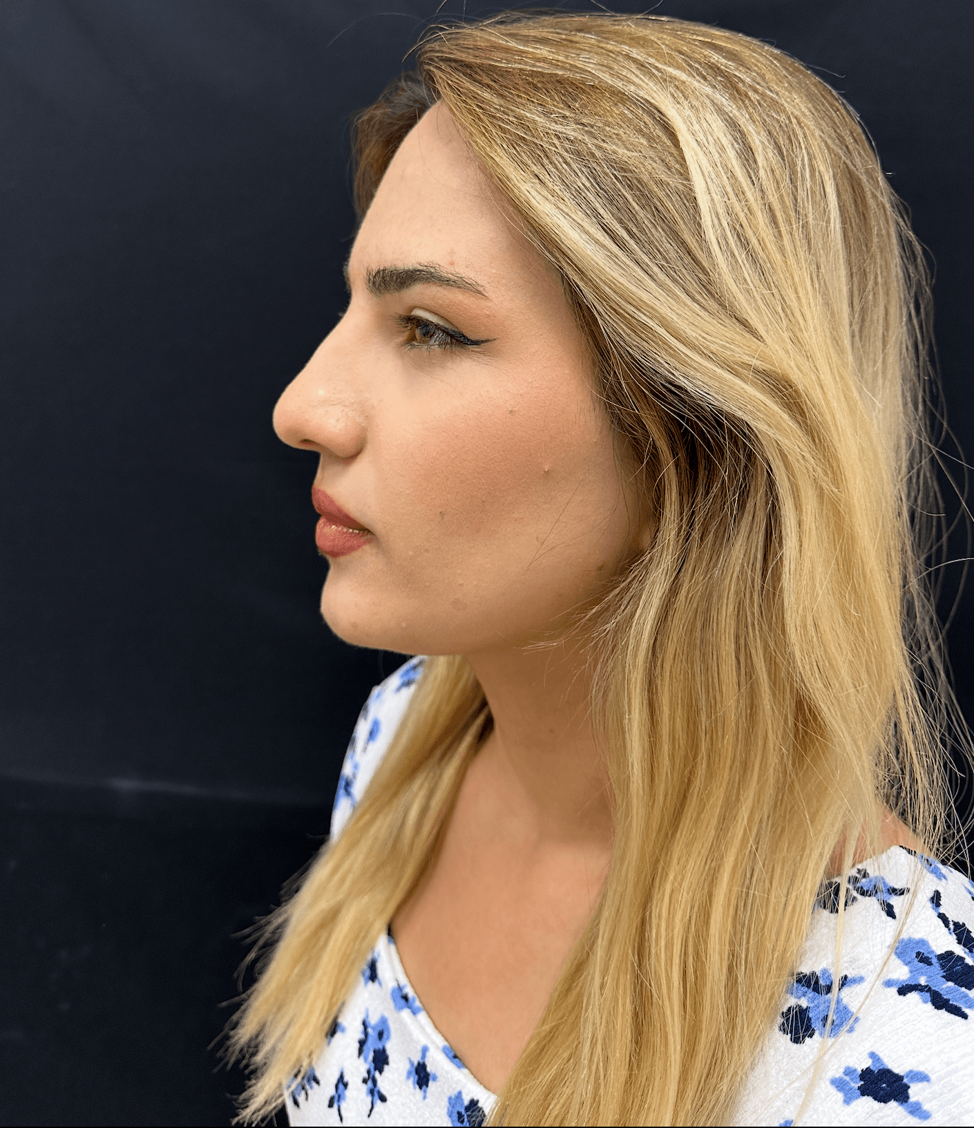 Revision Rhinoplasty Result 2 - After