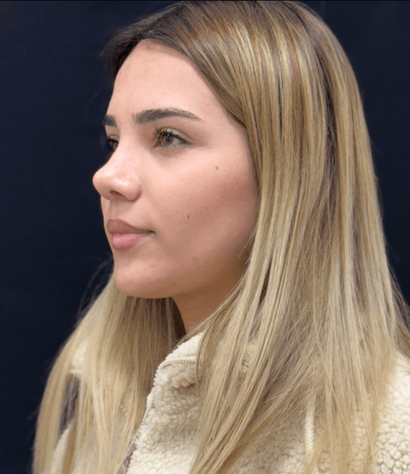 Revision Rhinoplasty Result 2 - Before