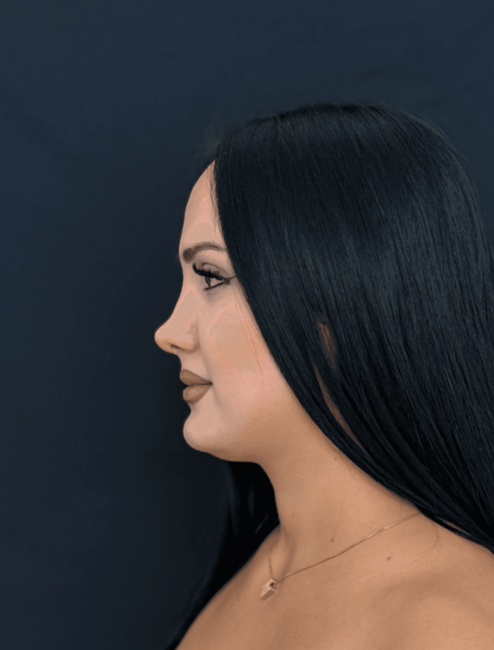 Revision Rhinoplasty Result 3 - After