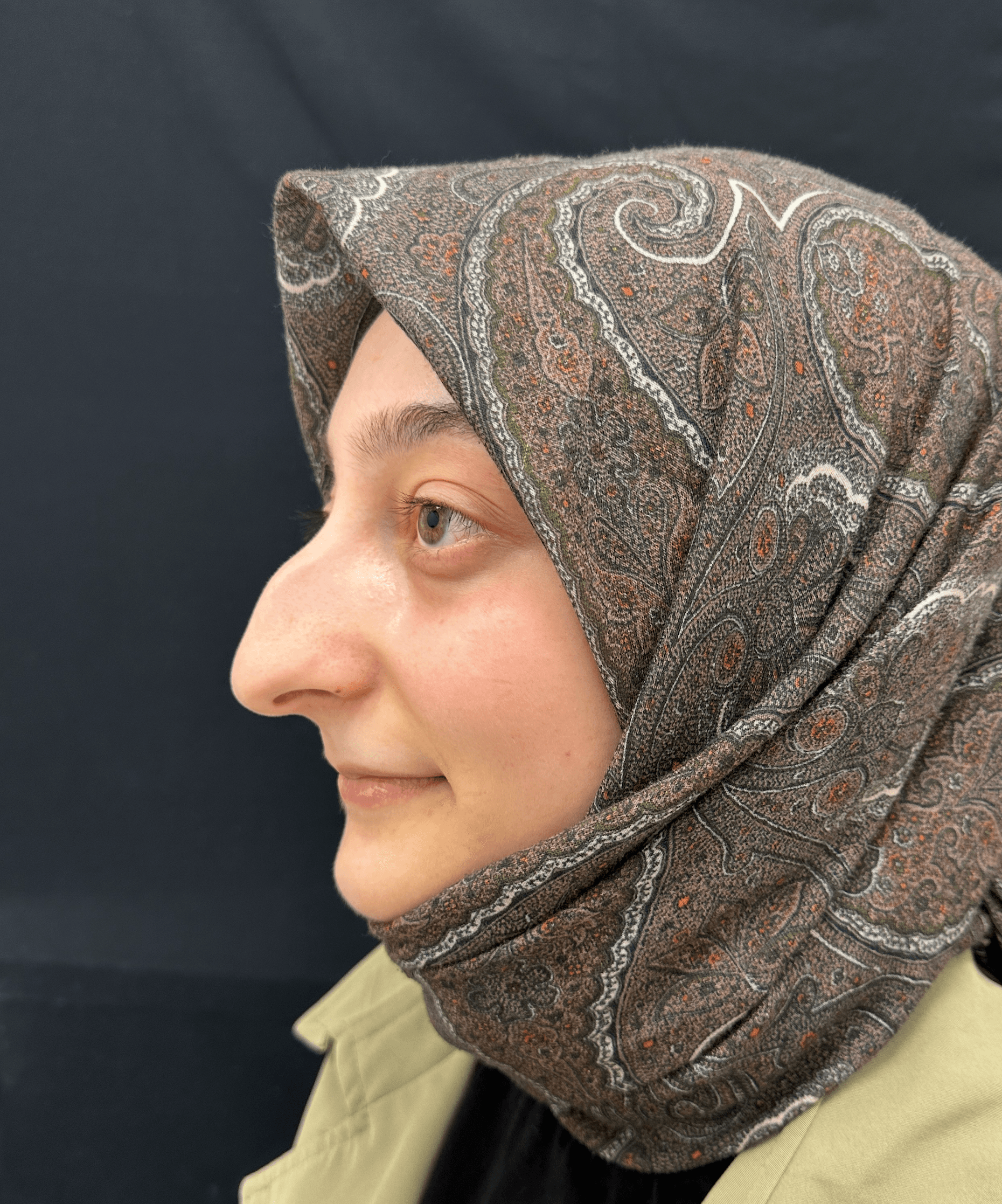 Ethnic Rhinoplasty Result 1 - Before