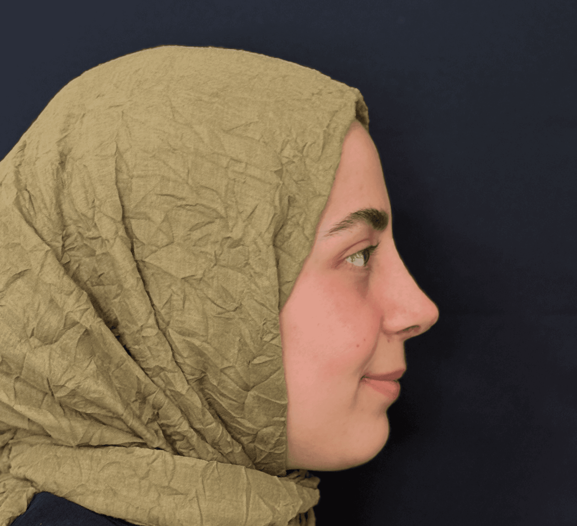 Revision Rhinoplasty